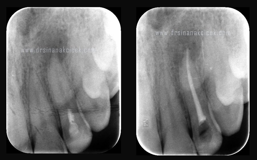 kanal-tedavisi-yenileme Kanal tedavisinin yenilenmesi