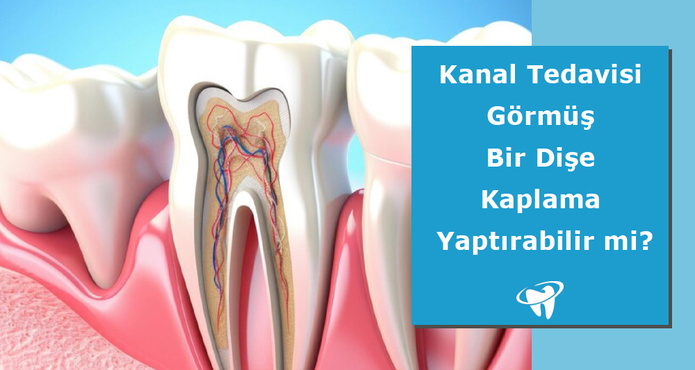 Dişe Kaplama