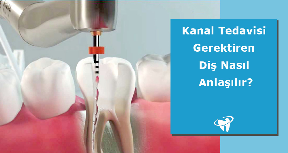 Kanal Tedavisi Gerektiren Diş