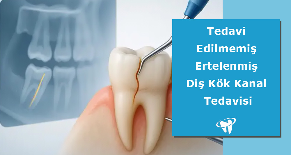 Tedavi Edilmemiş Ertelenmiş Kanal Tedavisi