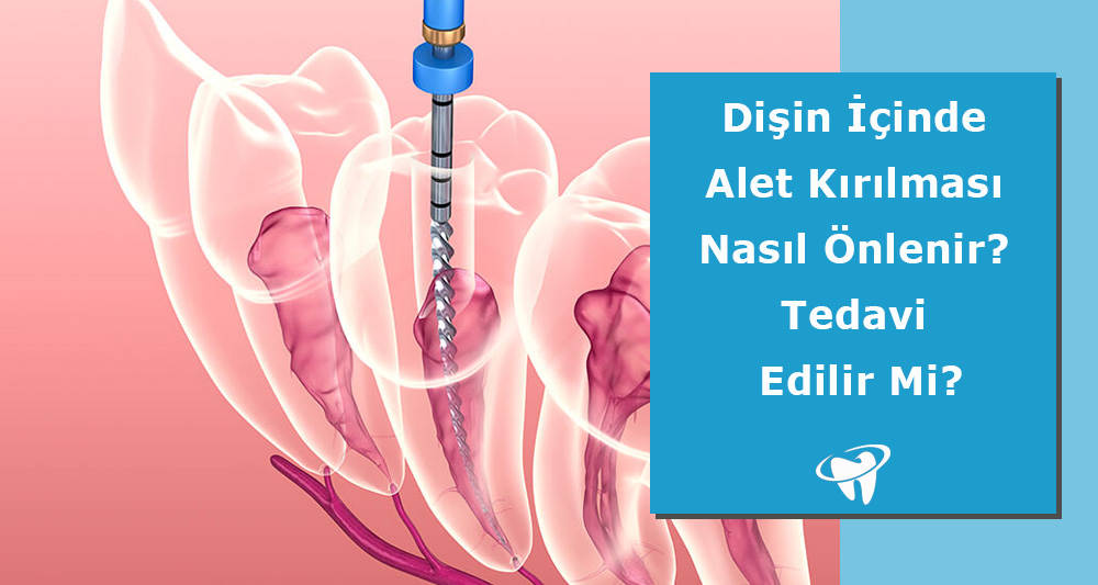 Dişin İçinde Alet Kırılması