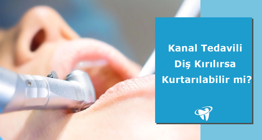 Kanal Tedavili Diş Kırılması