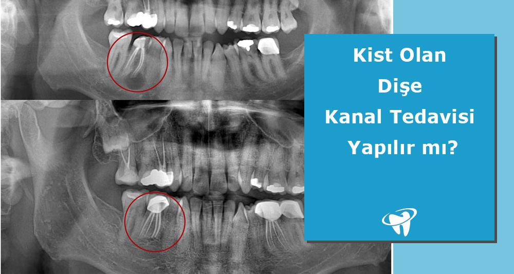 Kist Olan Dişe Kanal Tedavisi