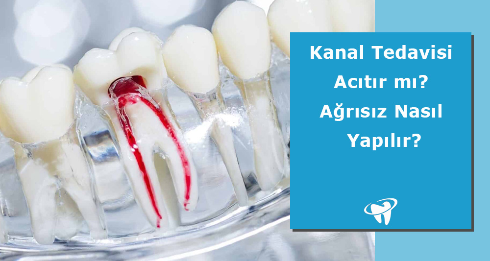 Kanal Tedavisi Acıtır mı?