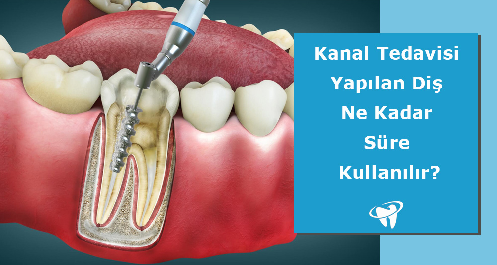 Kanal Tedavisi Yapılan Diş Ne Kadar Süre Kullanılır?