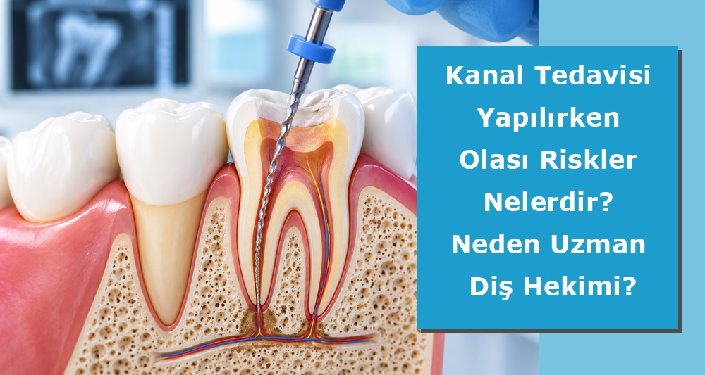 Kanal Tedavisi Yapılırken Olası Riskler Nelerdir? Neden Uzman Diş Hekimi?